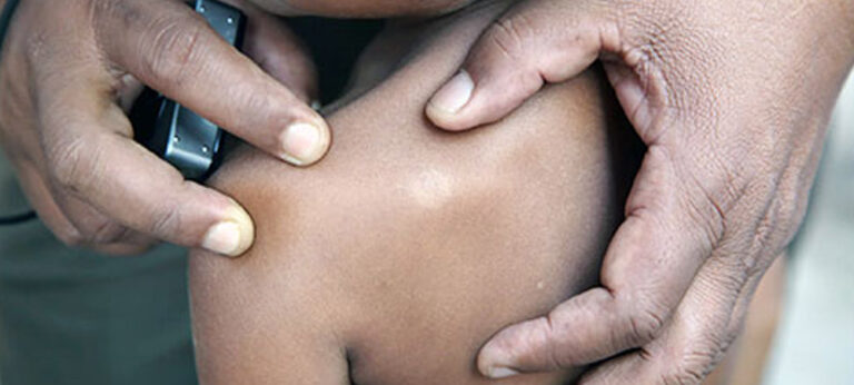 ළමා ලාදුරු රෝගීන් ඉහළට